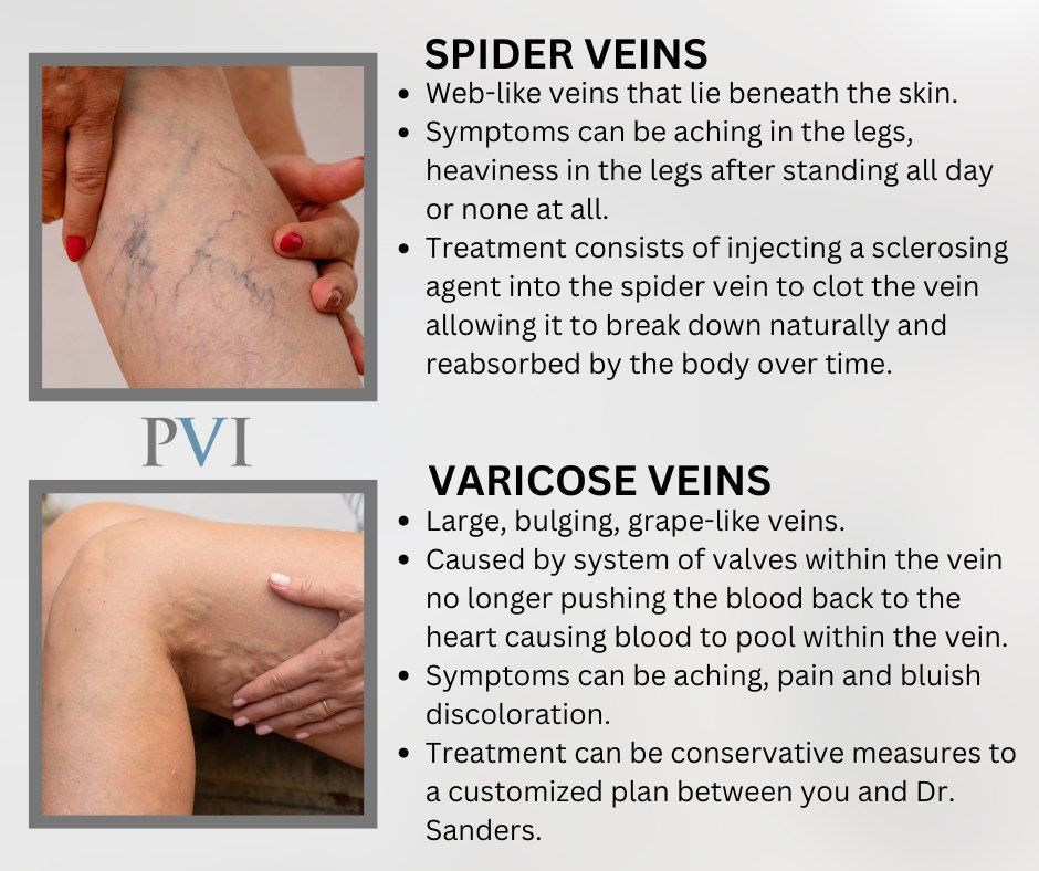 A picture of spider veins and varicose veins