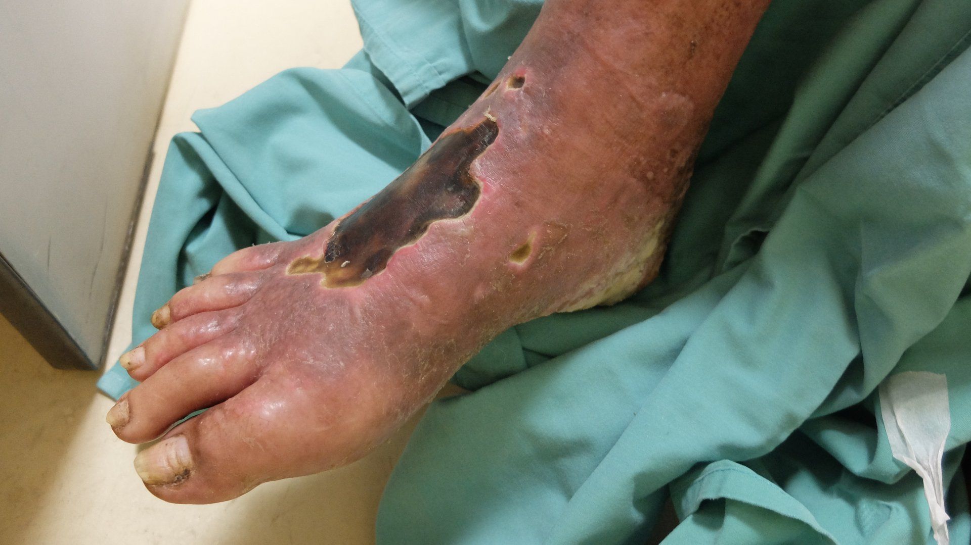 photo of arterial ulcers in a patients foot