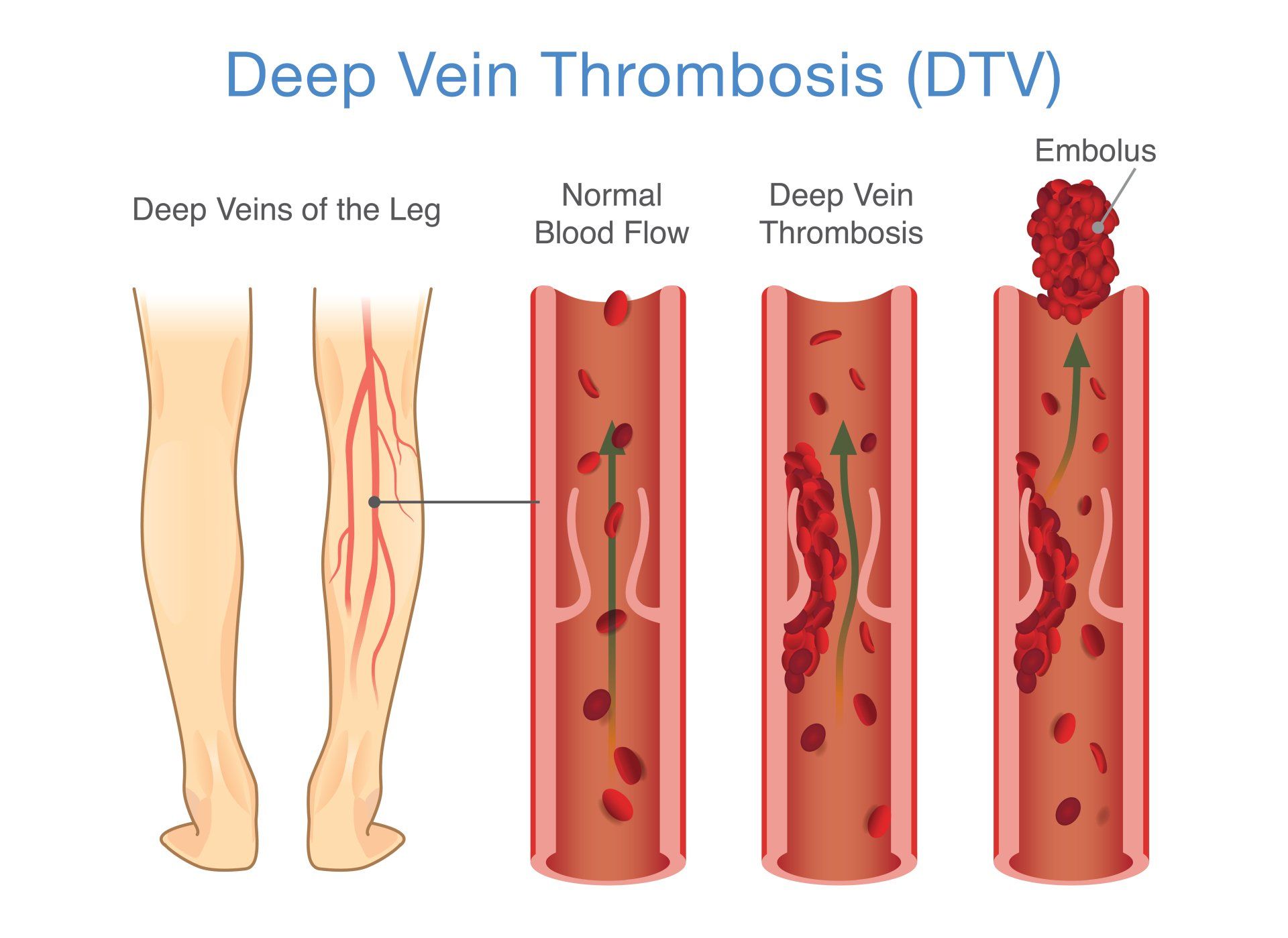 A diagram of deep vein thrombosis ( dtv ) on a white background.