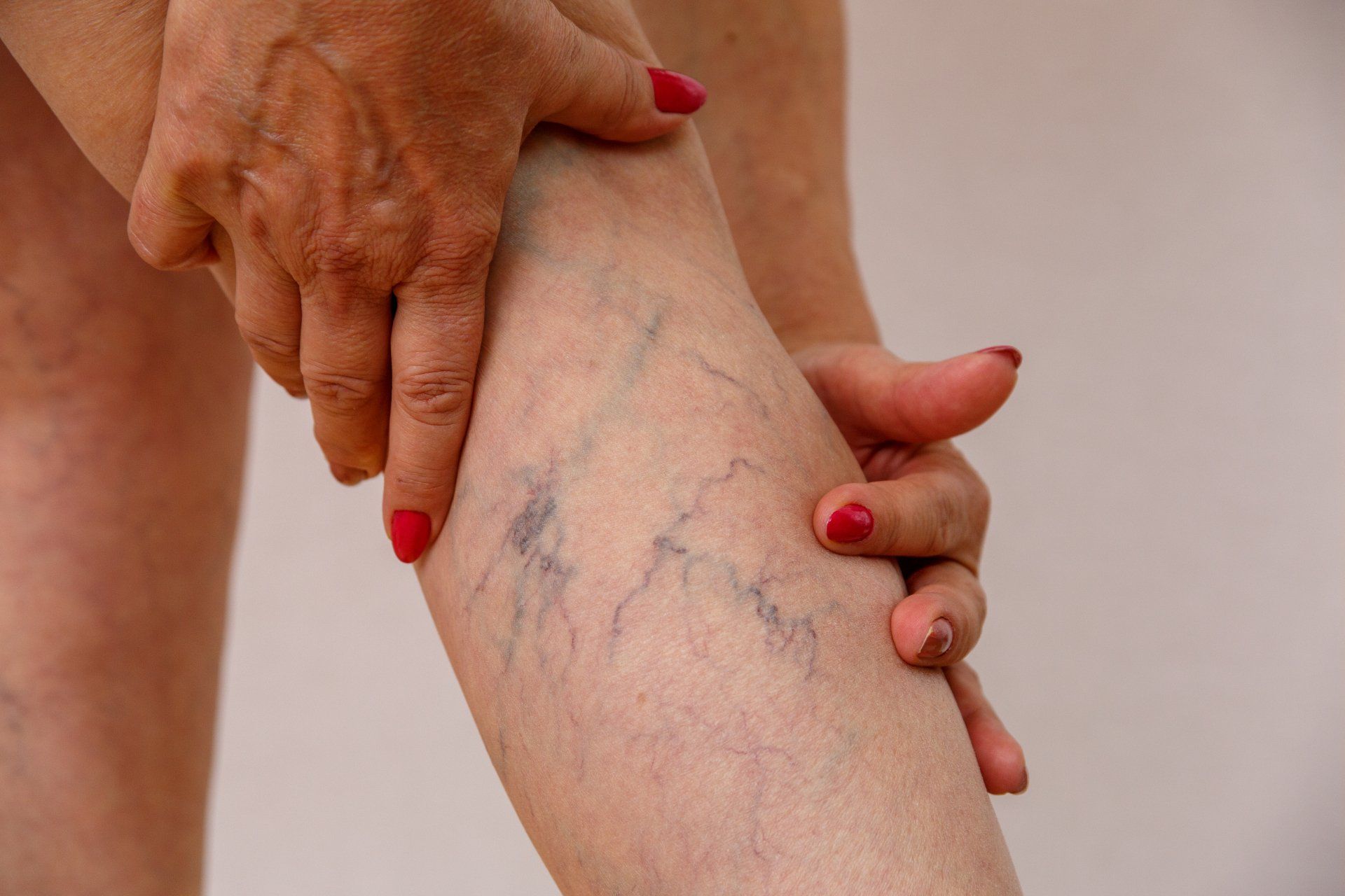 A woman with red nails is holding her leg with spider veins.