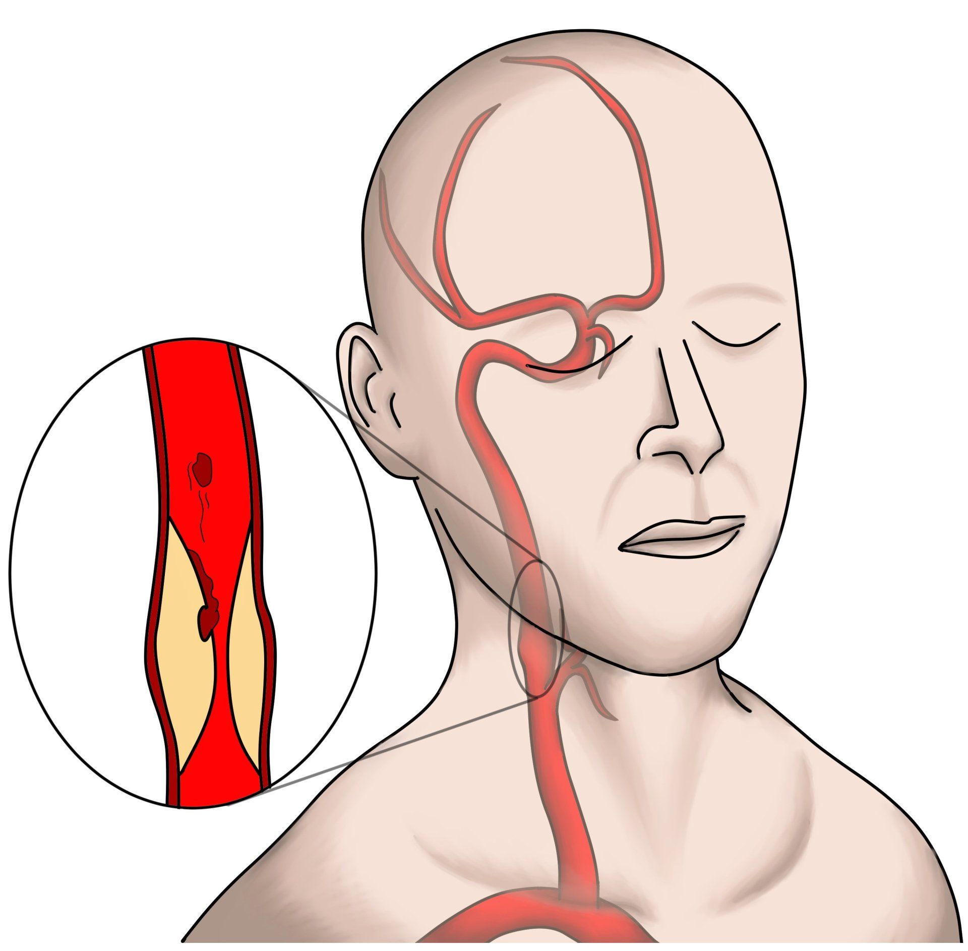 Carotid Artery Disease | Paducah Vascular Institute