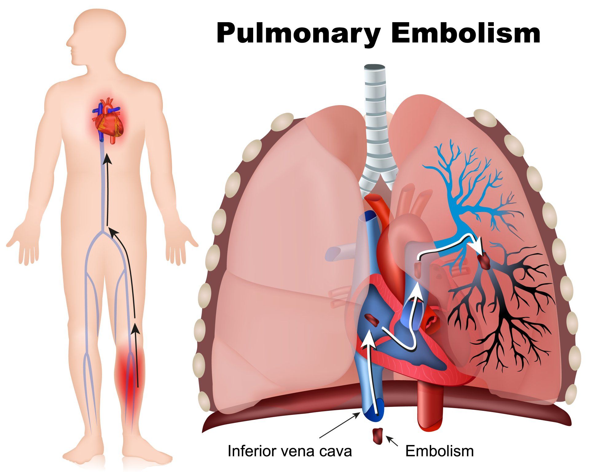 A diagram of pulmonary embolism in a human body