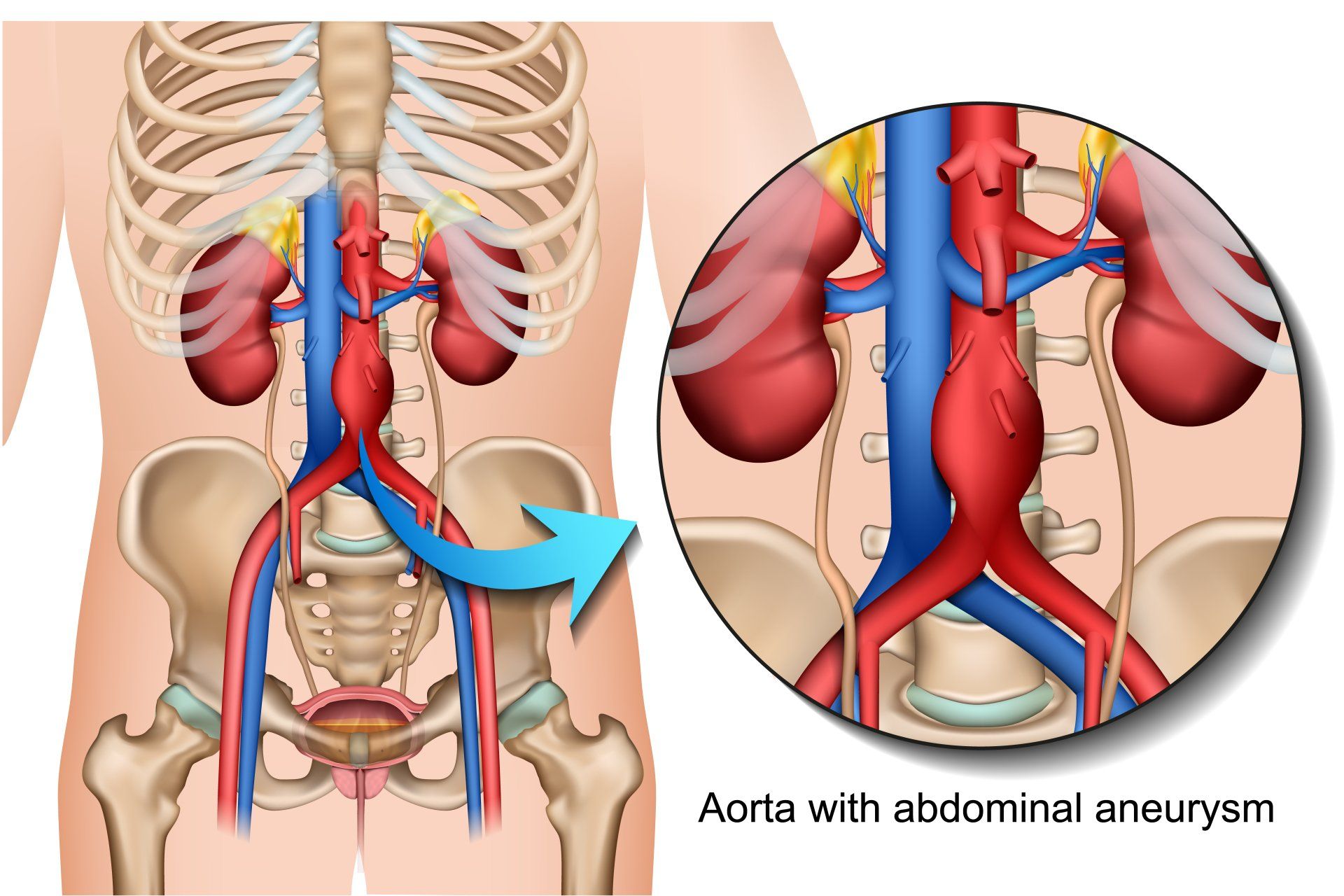 Abdominal Aortic Aneurysms Paducah Vascular Institute