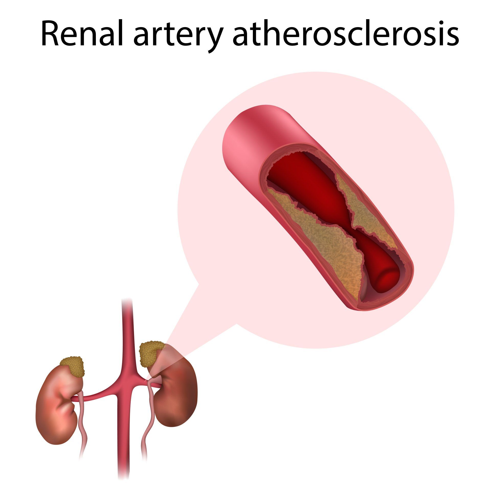 An illustration of renal artery atherosclerosis and kidneys.