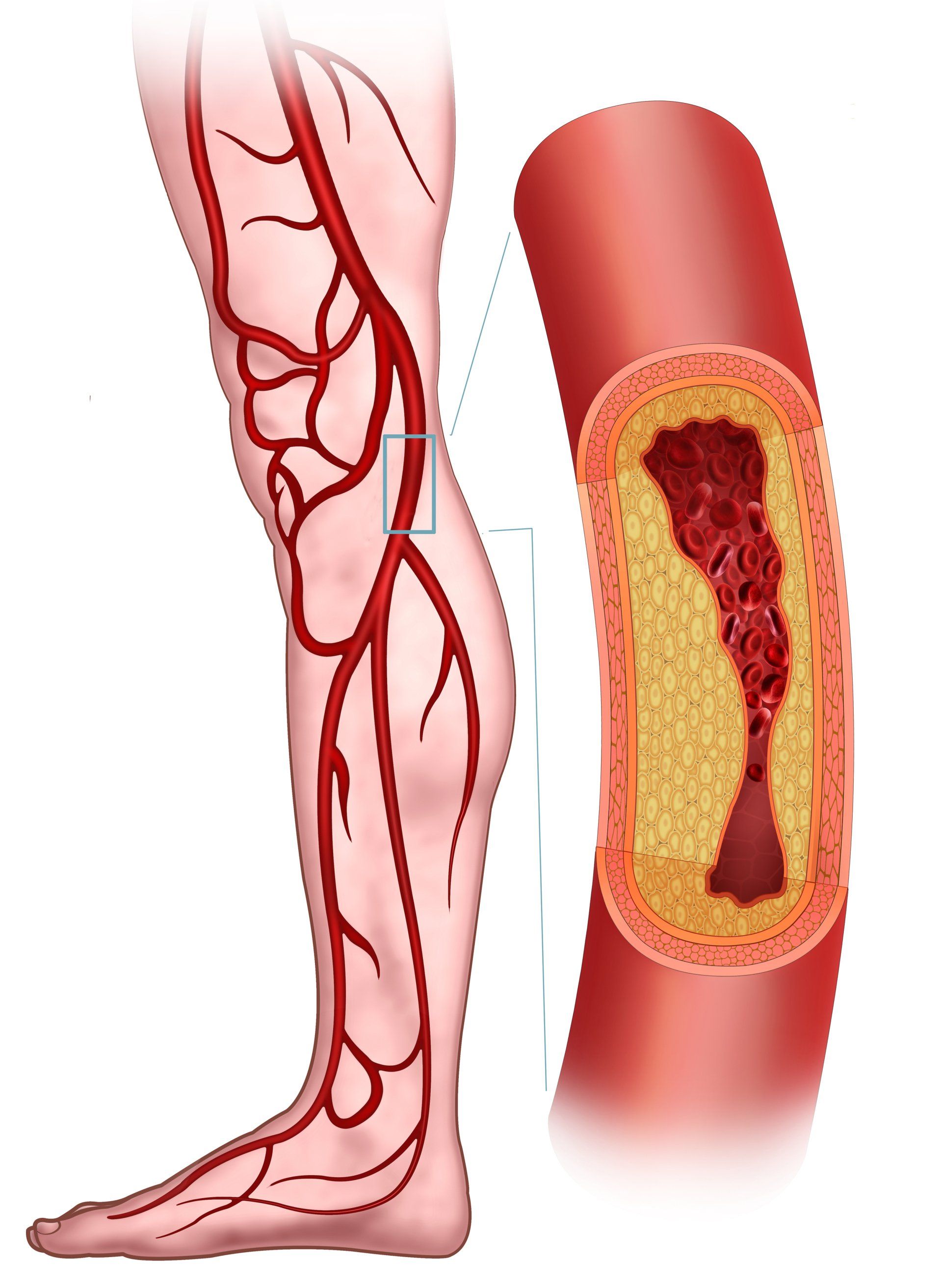 image of peripheral artery disease