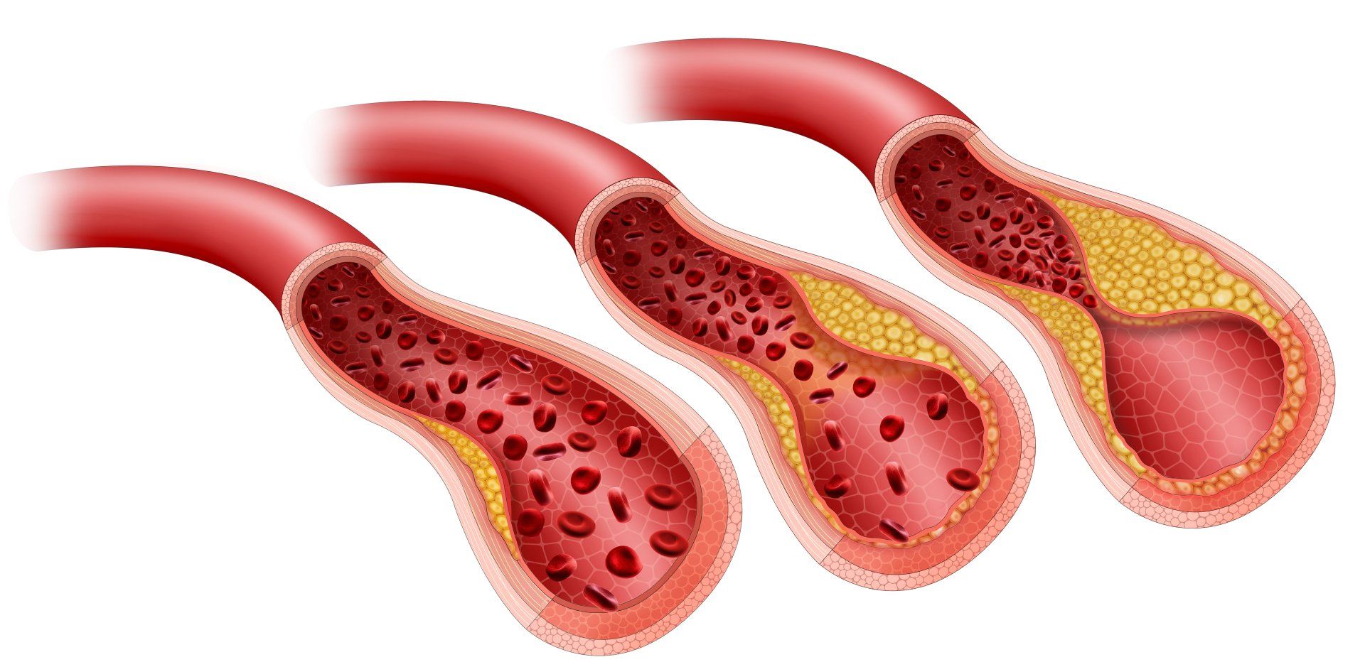 diagram of artery problems