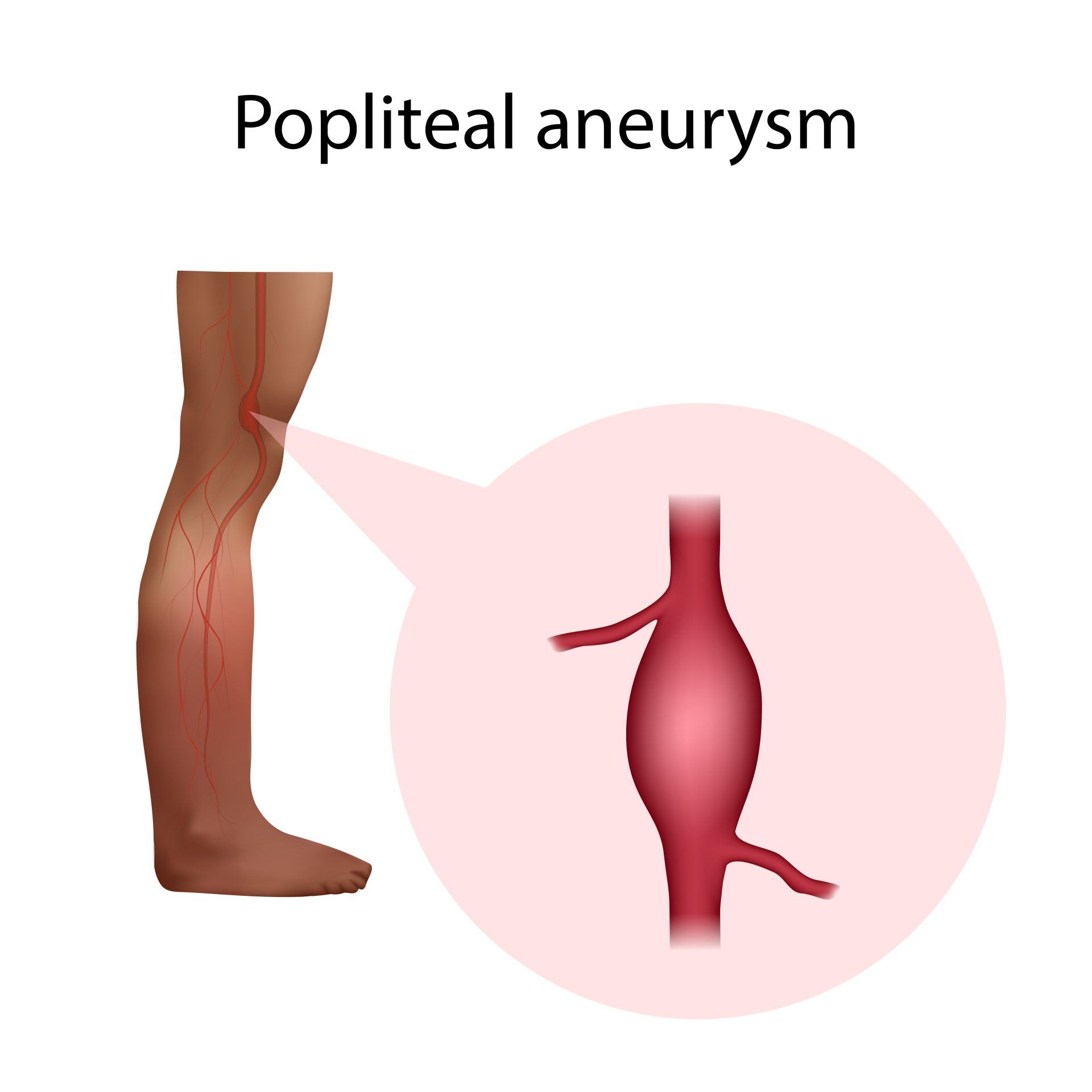 popliteal artery aneurysm icd 10