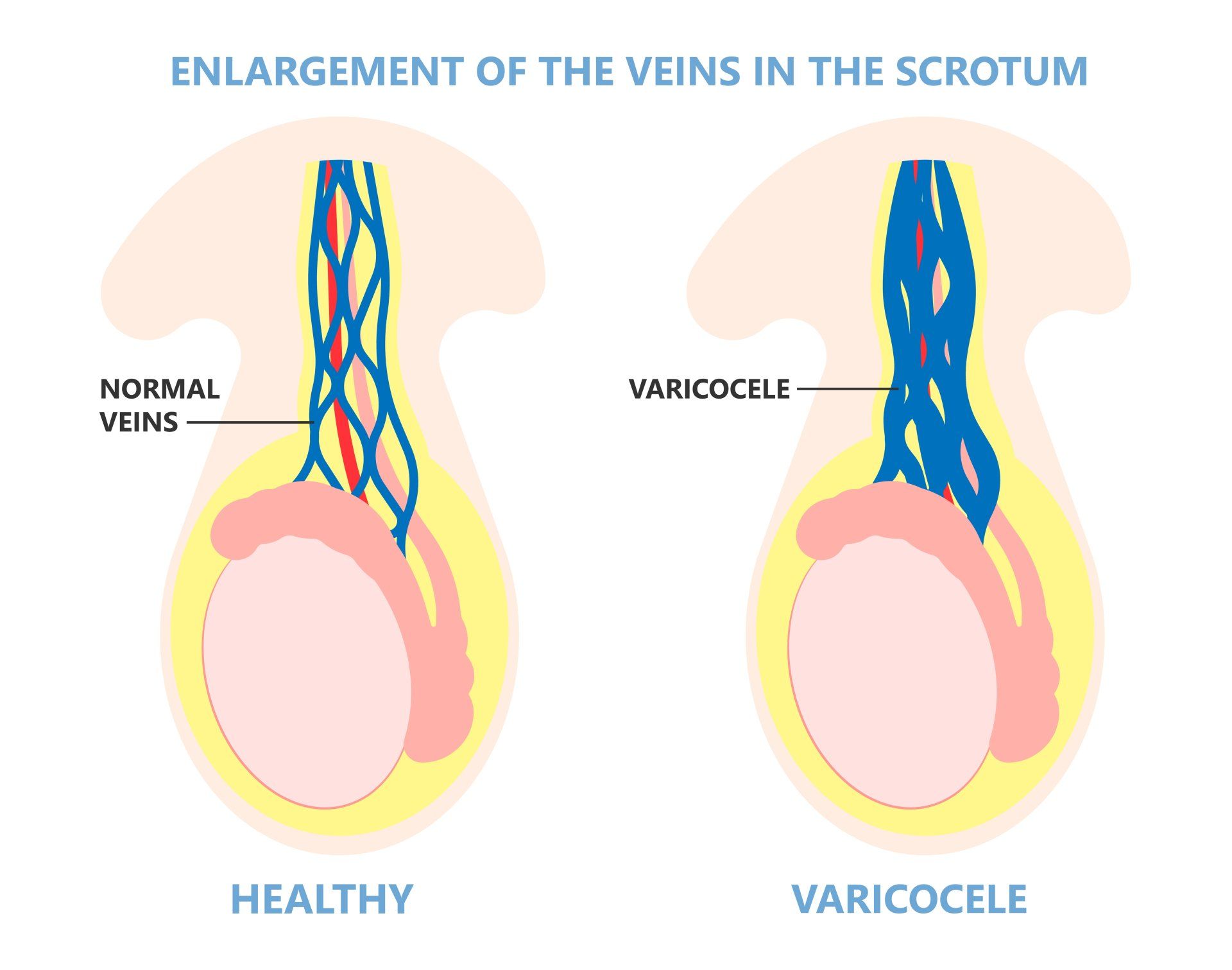 diagram of normal veins in testicle vs. varicose veins