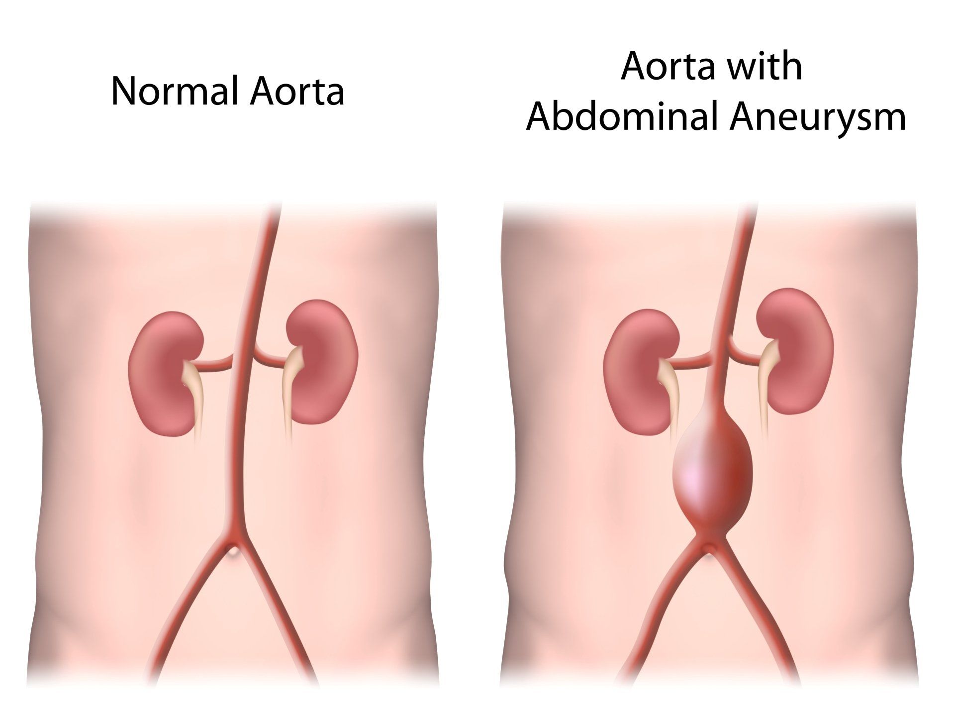 A normal aorta and an aorta with abdominal aneurysm