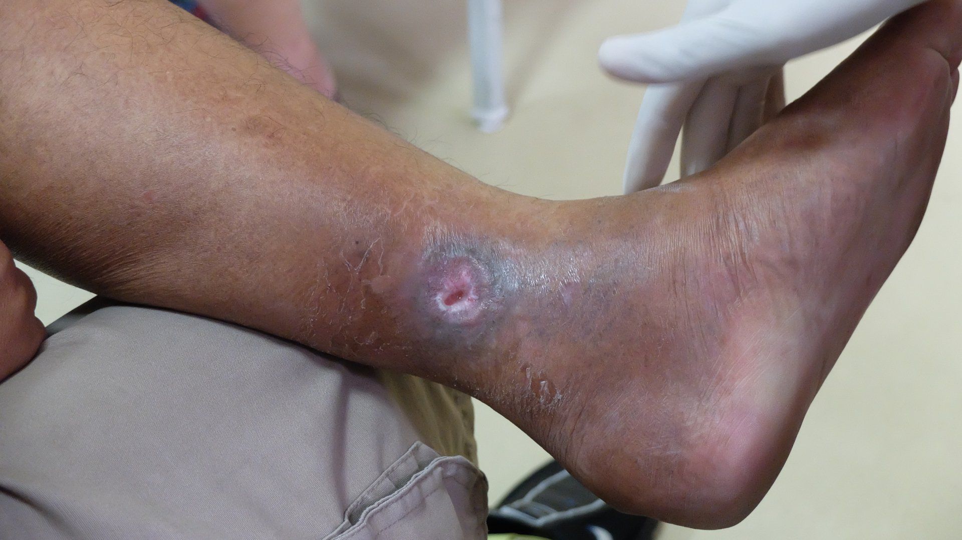 A close up of a person 's foot with a ulcer on it.