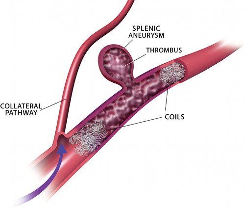 a diagram of a blood vessel showing splenic aneurysm and thrombus