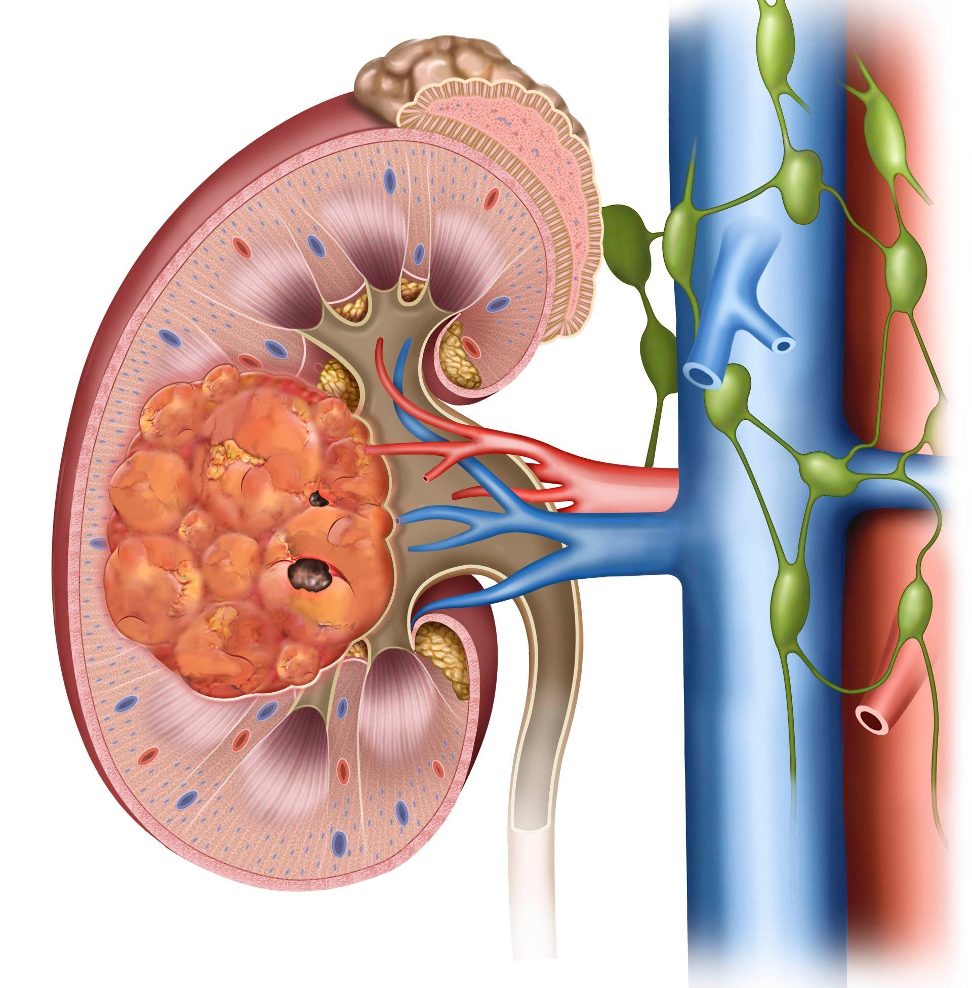 An illustration of a kidney with a tumor in it