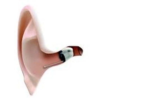 Protesi acustica realizzata su misura