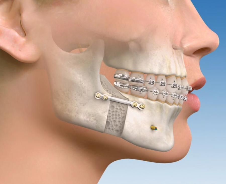 Ilustración médica de la mandÃbula de una persona con aparatos ortopédicos y hardware quirúrgico después de una cirugÃa ortognática.