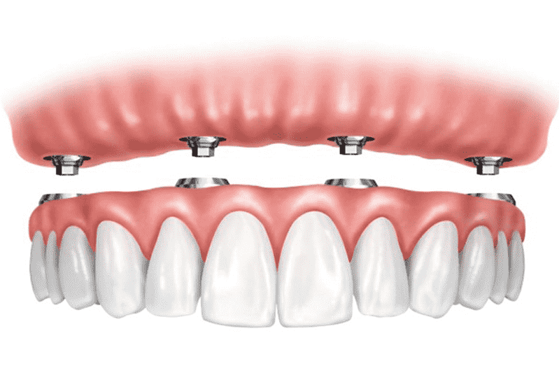 Ilustración de implantes dentales que sostienen un conjunto de dentaduras postizas superiores e inferiores.