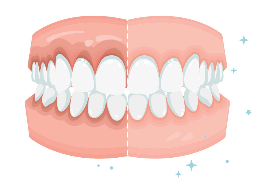 Comparación de blanqueamiento dental: el lado izquierdo tiene dientes y encías manchadas, el lado derecho tiene dientes blancos brillantes y encías rosadas.