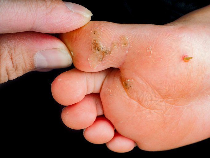 Child's foot sole, with verruca, wart, callus isolated towards black.