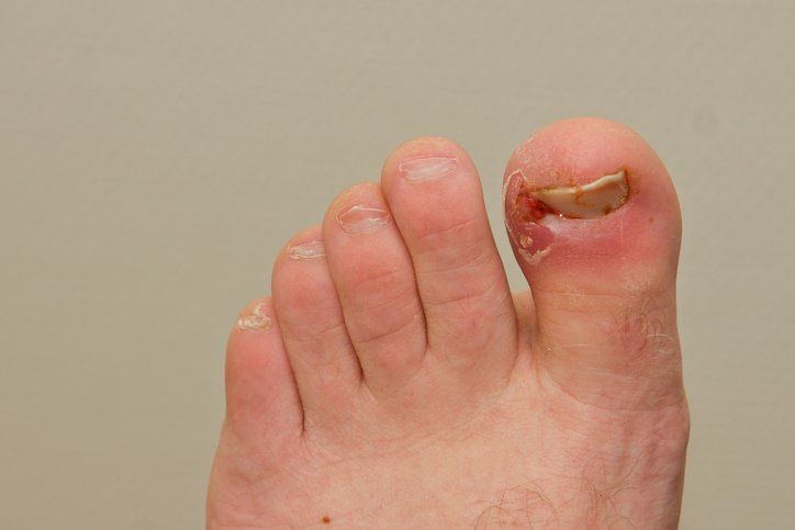 Ingrown toenail