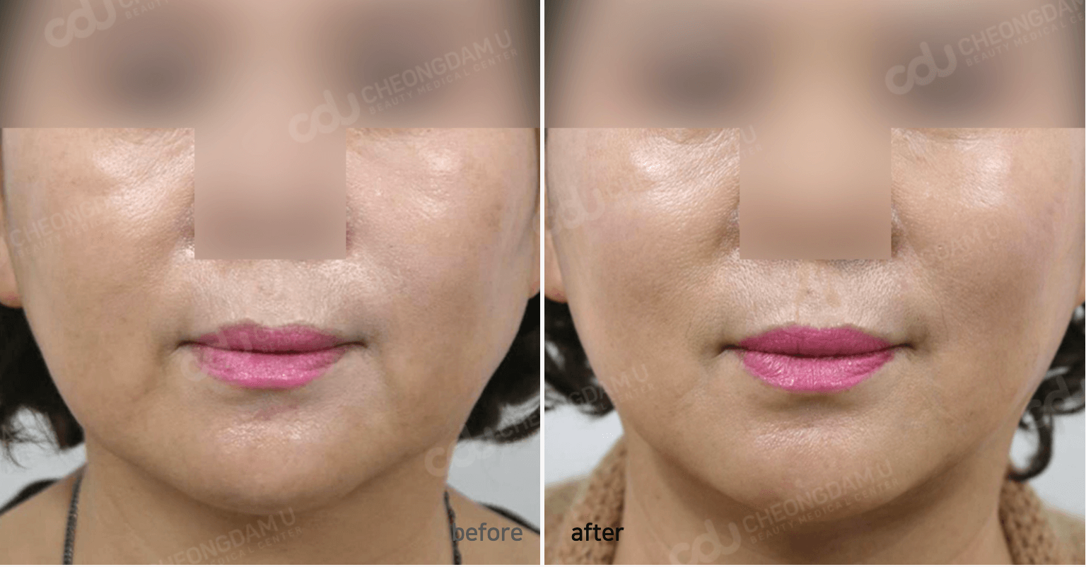 v실리프팅+윤곽주사 정면 2개월