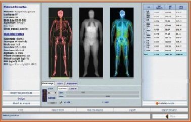 ricostruzione 3d di osso affetto da osteoporosi