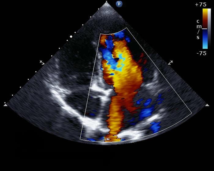 ECO-COLOR-DOPPLER CARDIACO