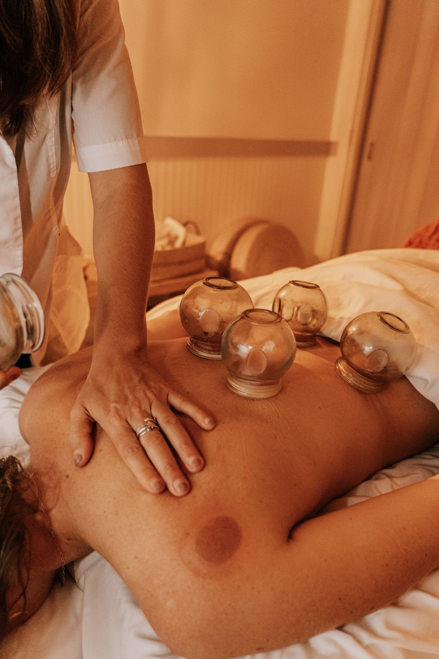 Person receiving cupping therapy on their back, indoors. Cups suctioned to skin, practitioner's hands on back.