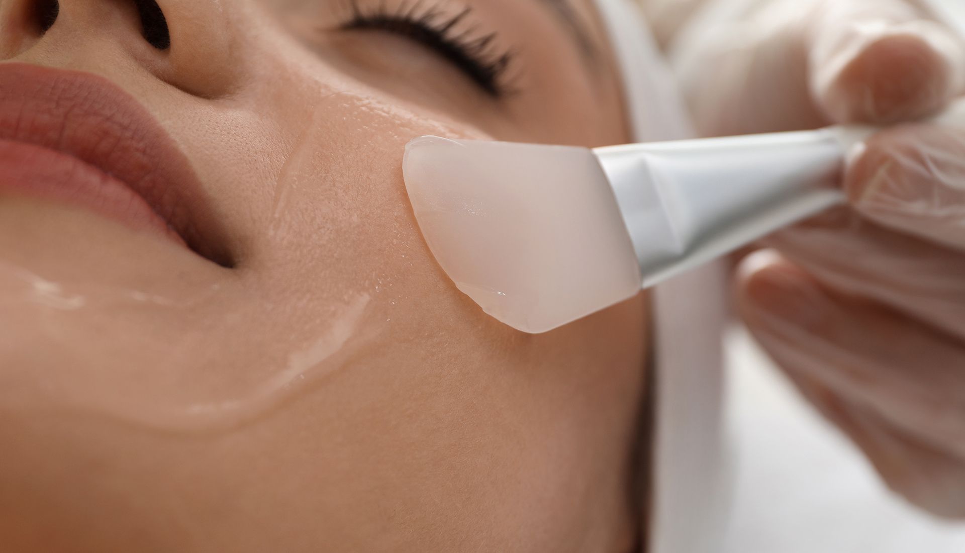 A person receiving a chemical peel treatment; a brush applies a clear liquid to the cheek.