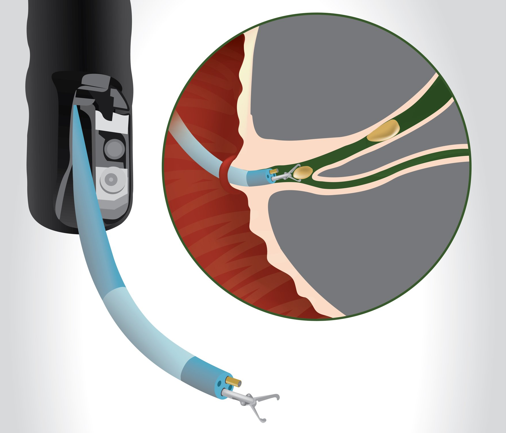 Endoscopic medical procedure: tool removing gallstones from a duct.