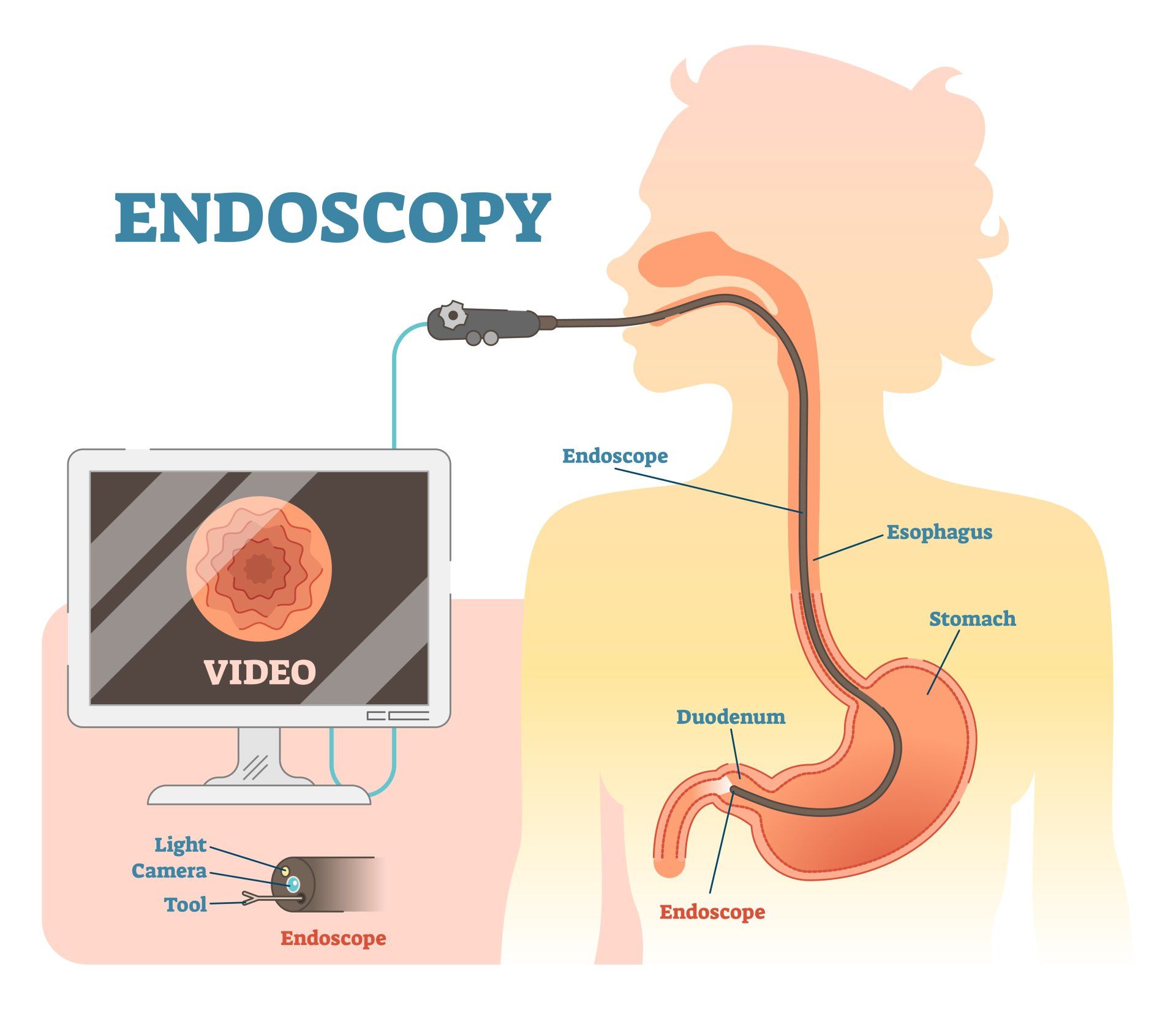 Diagram showing an endoscopy procedure; a scope inserted through the mouth to view the digestive tract.