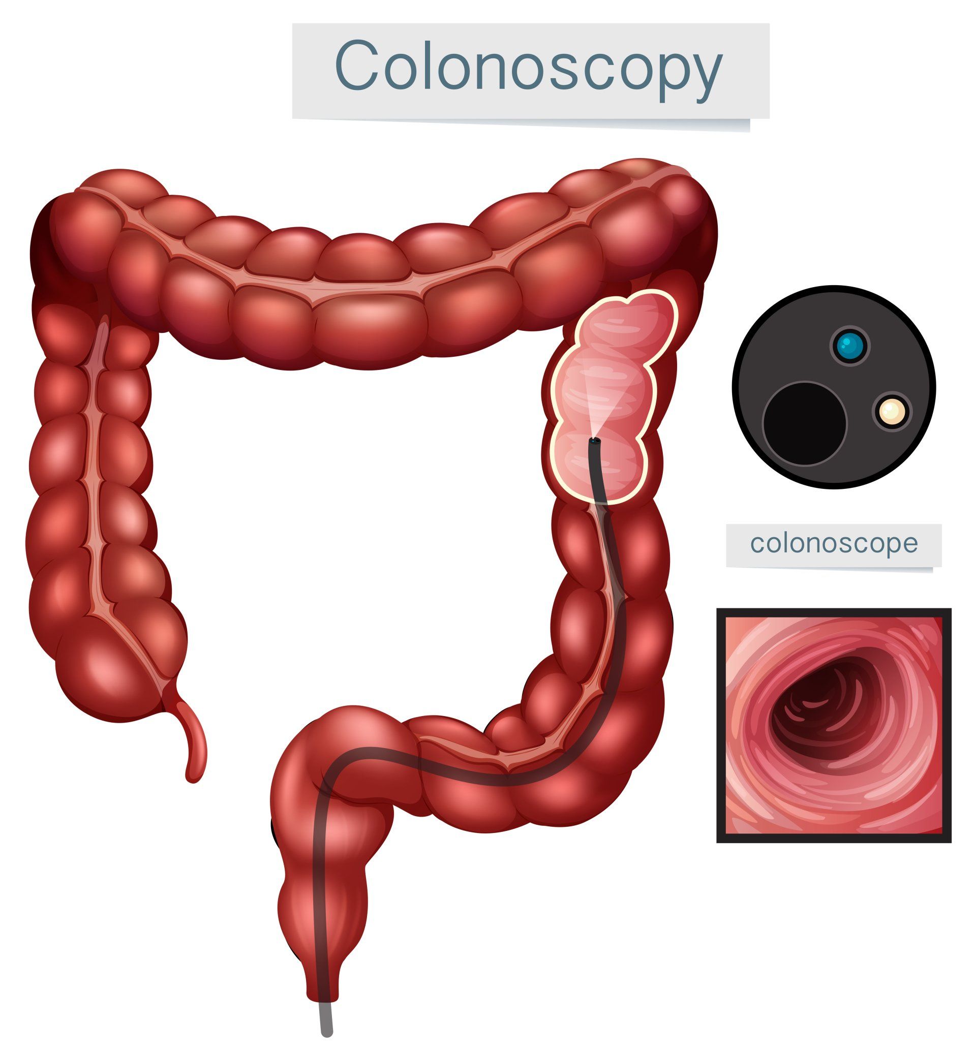Colonoscopy diagram: A medical illustration showing a colon and a colonoscope inside, with a polyp highlighted.