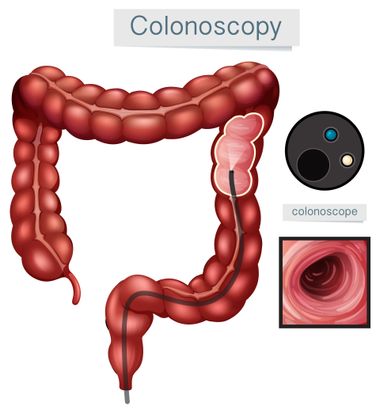 Colonoscopy Procedure Diagram