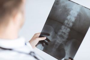 A doctor is holding an x-ray of a person 's spine.