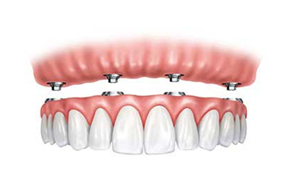 Dental Implant Image | Dentist for dental implants and smile makeovers in Lynnwood WA 98036