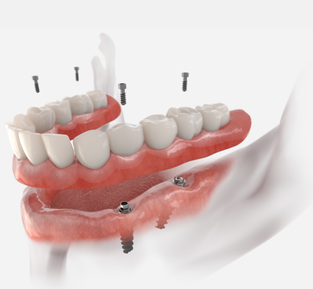 The Dental Implant Procedure | Dentist in Lynnwood WA