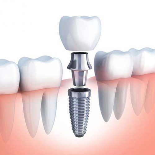 Implantes dentales en Guadalajara
