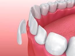 Un primer plano de los dientes de una persona con una carilla dental.