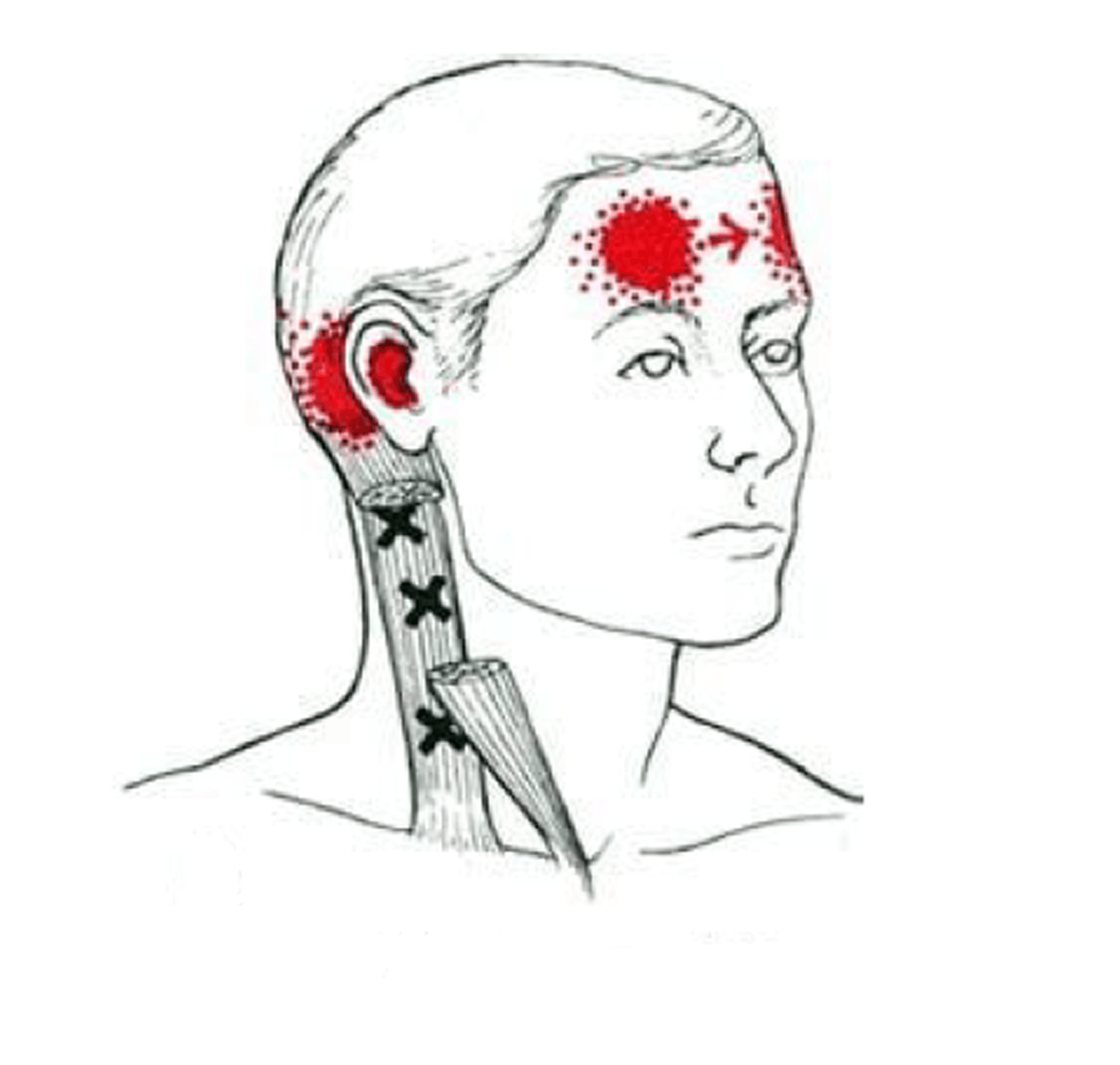 A drawing of a person 's head and neck with a red spot on the forehead.