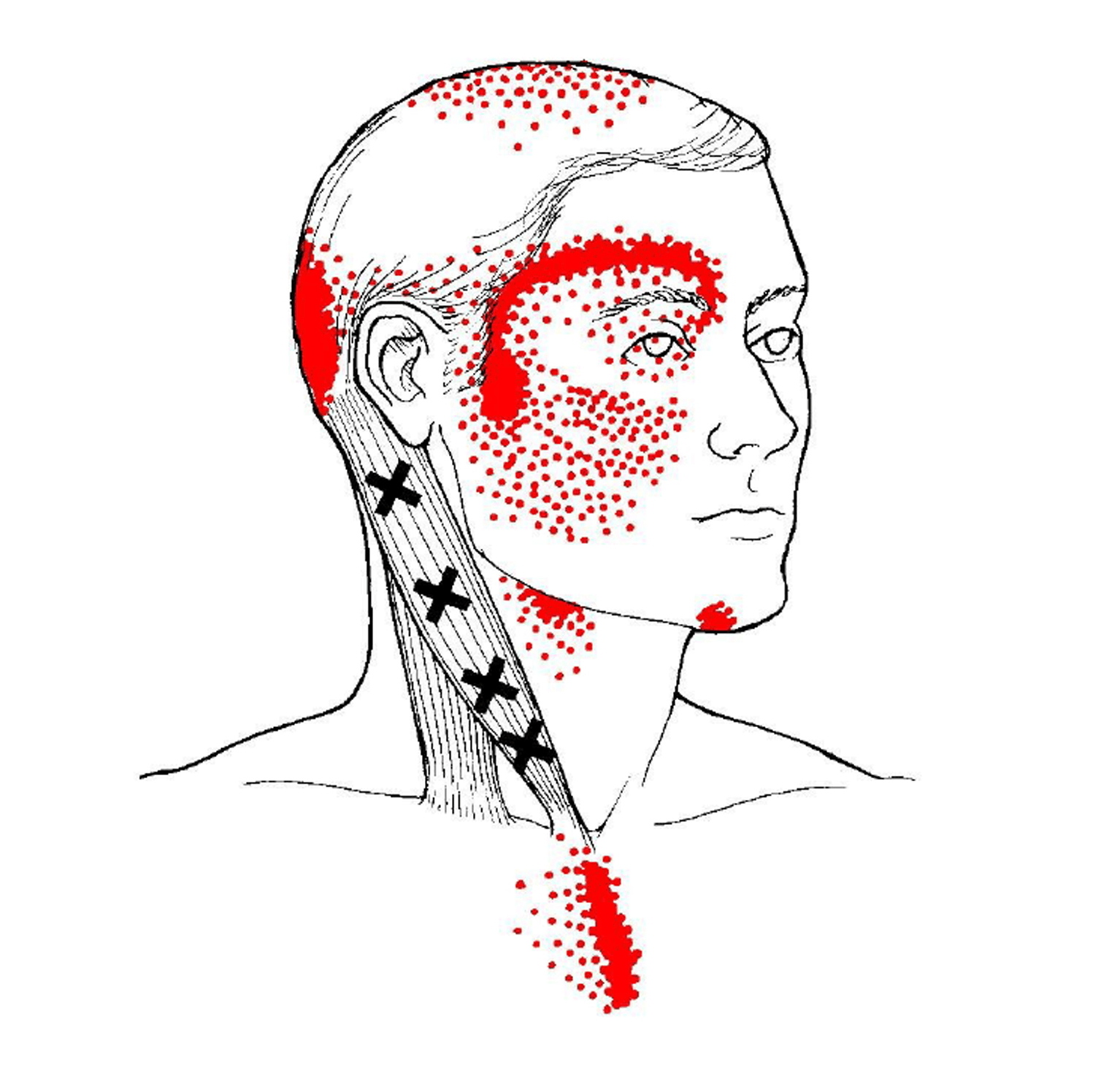 A black and white drawing of a man 's head with red spots on it.