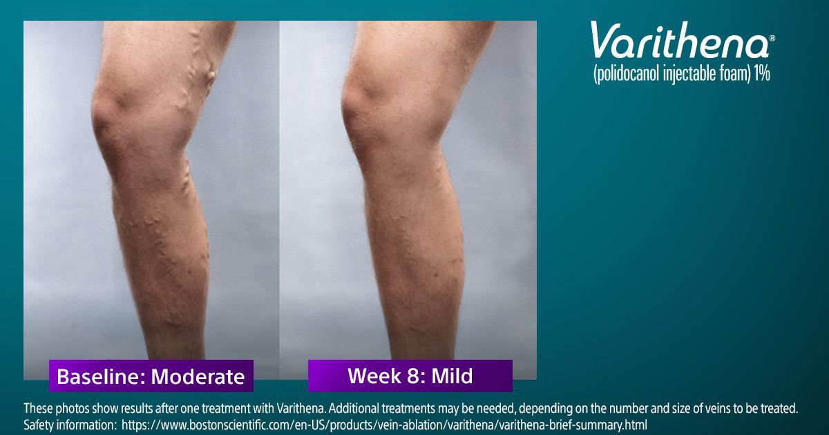 A picture of a person 's legs showing a baseline moderate and a week 8 mid