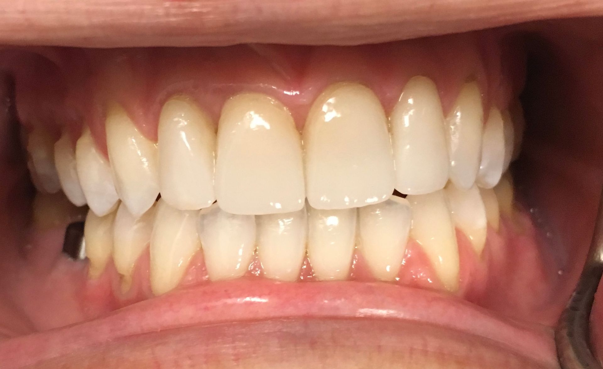 A close up of a person 's teeth with white teeth.