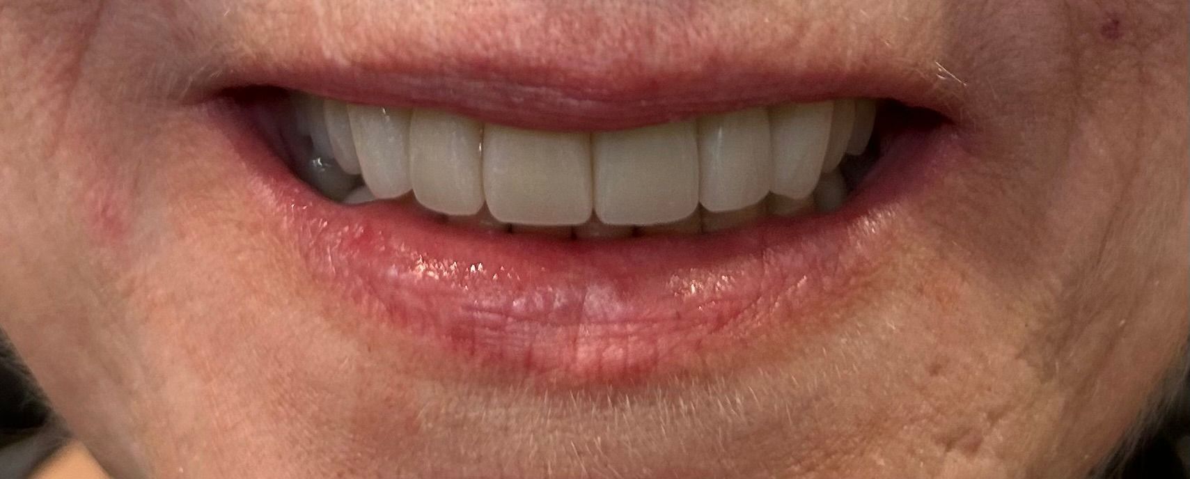 A close up of a woman 's smile with white teeth.