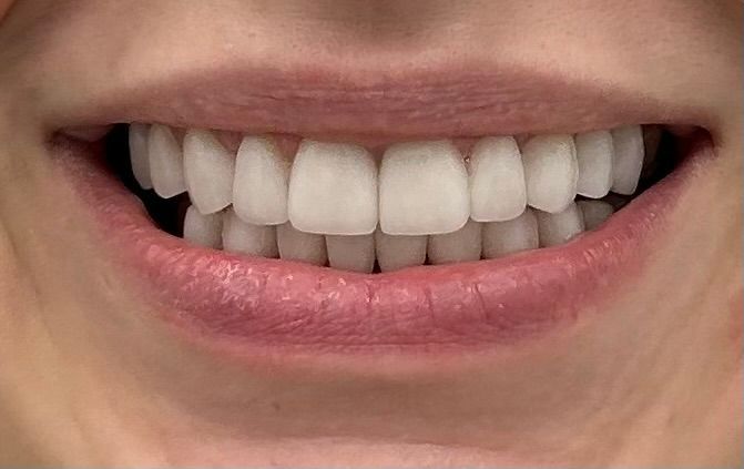 A close up of a woman 's smile with white teeth.