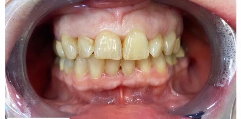 A close up of a person 's teeth with a broken tooth.