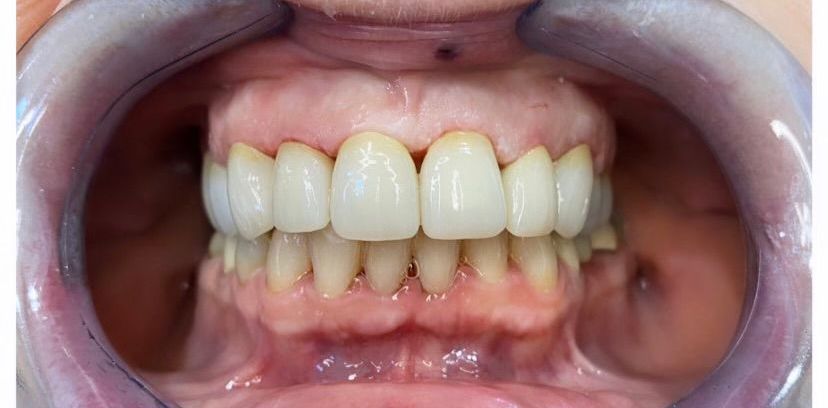 A close up of a person 's teeth with white teeth.