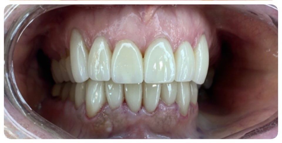 A close up of a person 's teeth with white teeth.