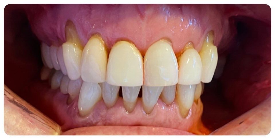 A before and after picture of a person 's teeth.