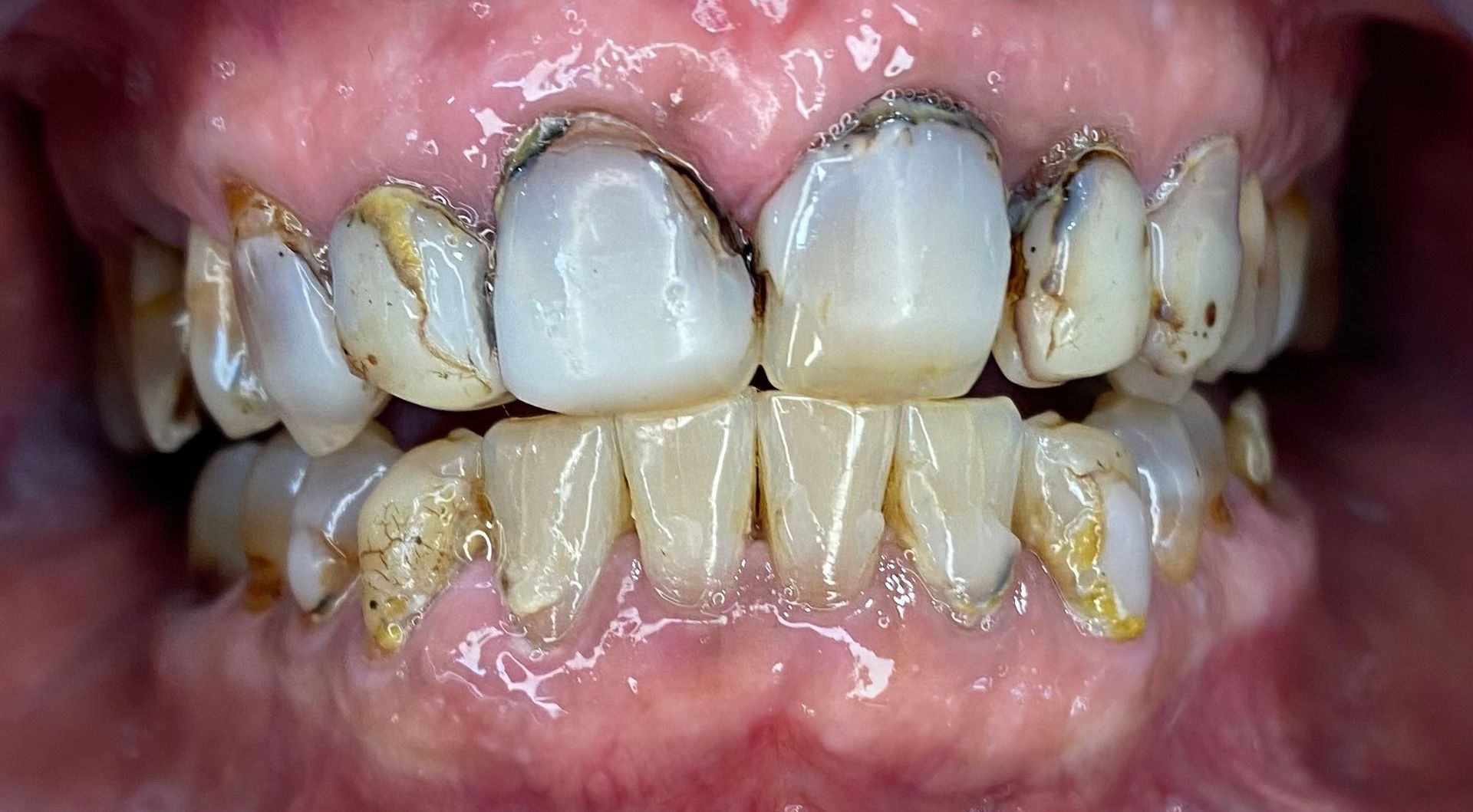 A close up of a person 's teeth with a lot of plaque on them.