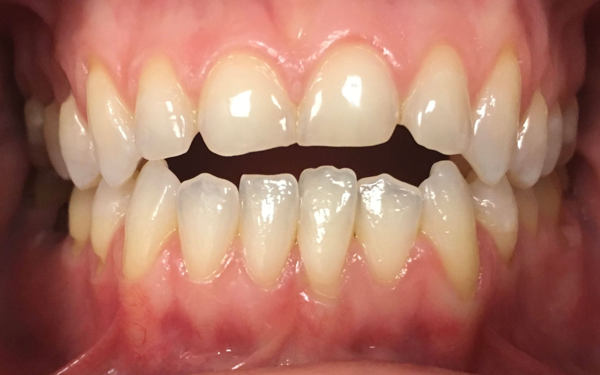 A close up of a person 's teeth with a broken tooth.