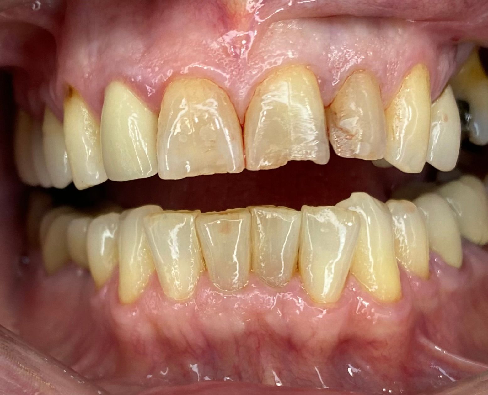 A close up of a person 's teeth with a broken tooth.