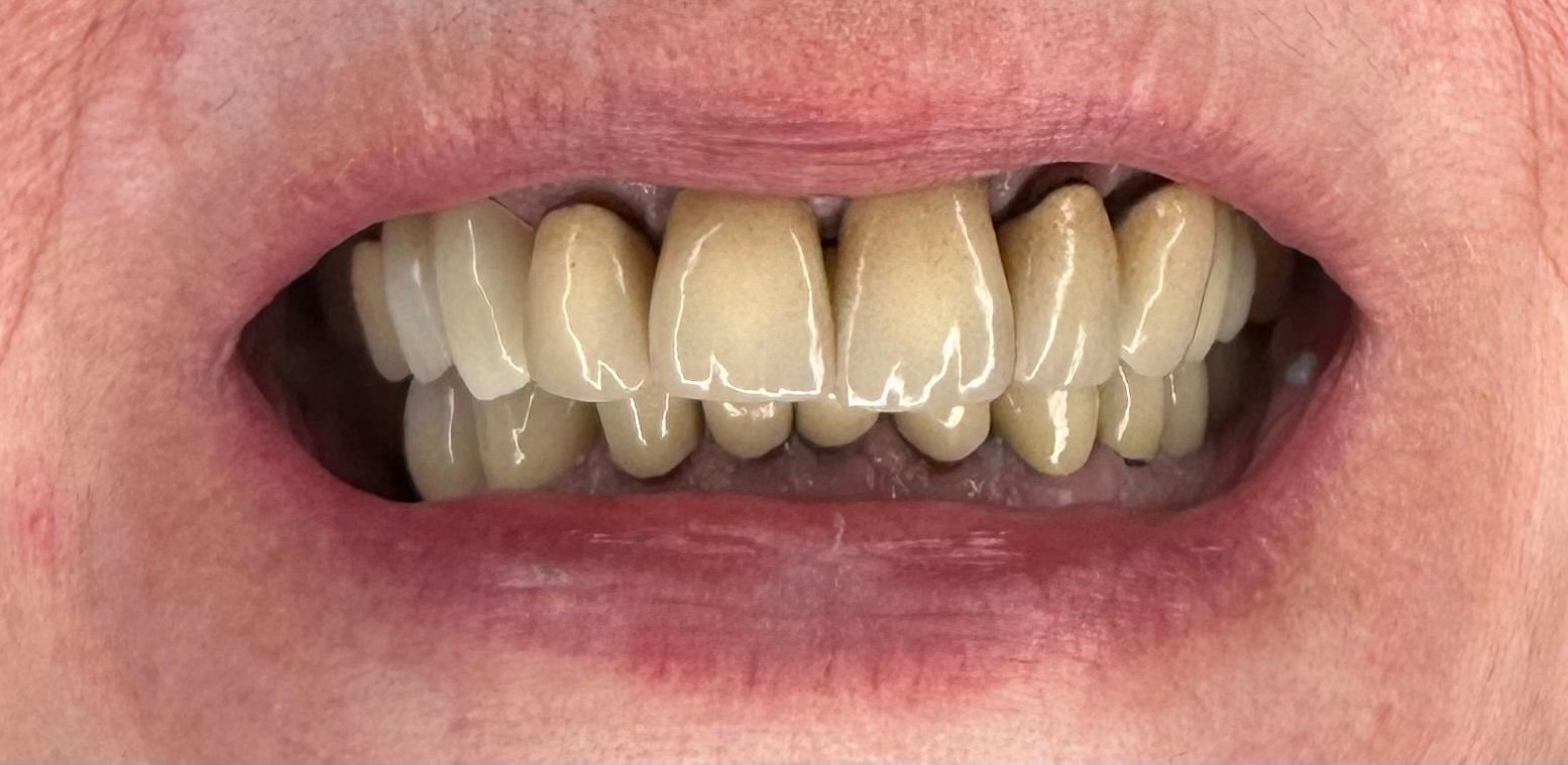 A close up of a person 's teeth with a lot of plaque on them.